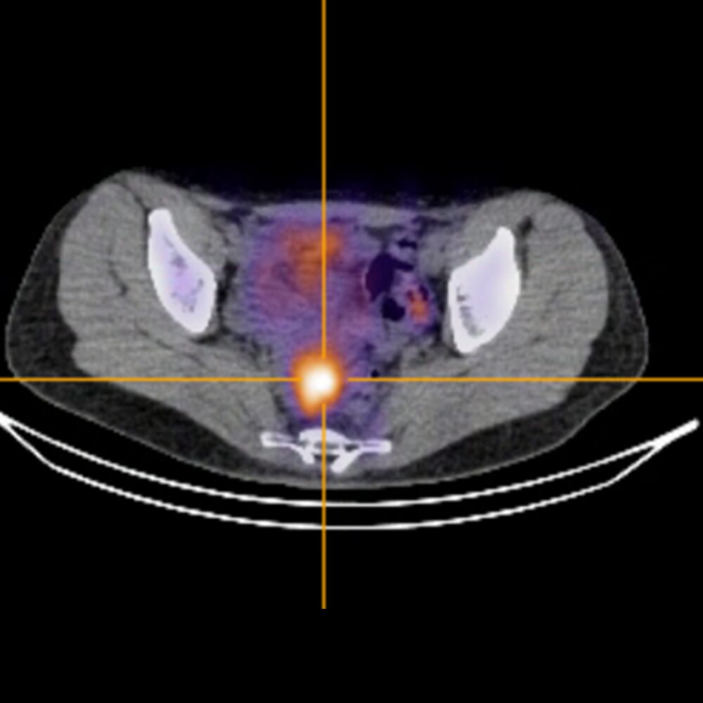 Pelvic Xtray Scan