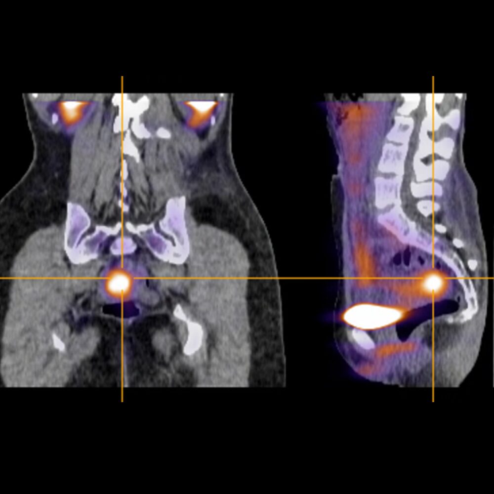 Pelvic Body Xtray Scan